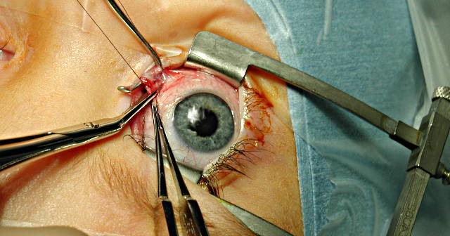 Операция по удалению бельма на глазу