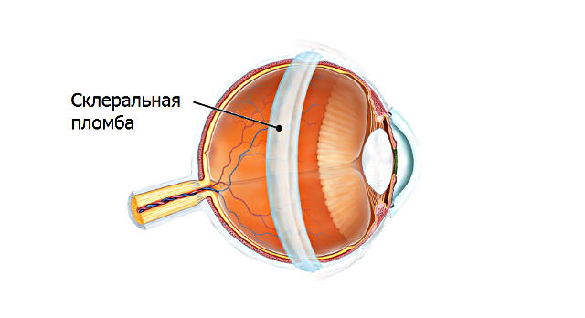 Эписклеральное пломбирование сетчатки глаза