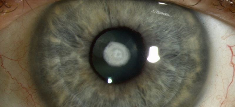 Полярная катаракта