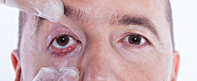 Причины и симптомы халязиона глаза