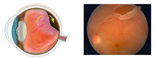 Причины развития отслоения сетчатки глаза