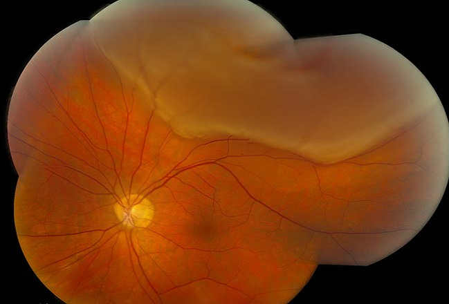 Причины регматогенной отслойки сетчатки глаза