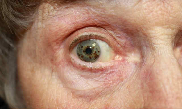 Диабетическая ретинопатия - осложнения