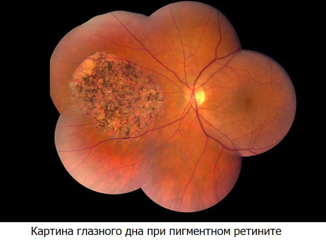 Ретинит (воспаление сетчатки глаза)