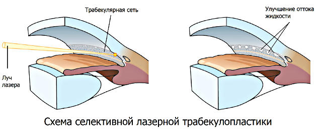 Селективная лазерная трабекулопластика (СЛТ) при глаукоме