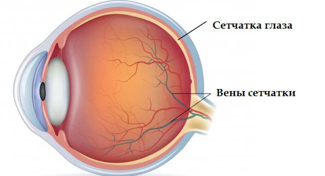 Диабетическая ангиопатия сетчатки обоих глаз
