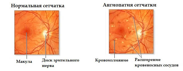 Ангиопатия сетчатки глаза по гипертоническому типу (обоих глаз)