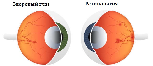 Ретинопатии сетчатки глаза - стадии