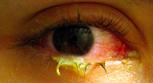 Симптомы конъюнктивита глаз у детей и взрослых