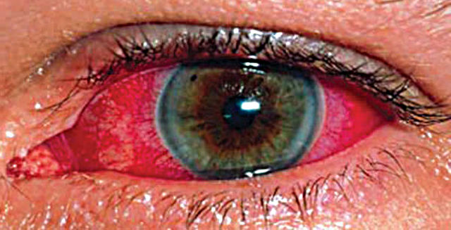 Симптомы ожога глаз роговицы и слизистой