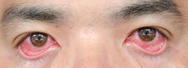 Симптомы и признаки конъюнктивита глаза