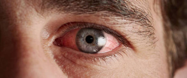 Аллергический конъюнктивит глаз - причины и симптомы