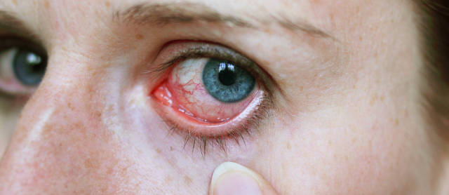 Причины и симптомы вирусного конъюнктивита глаз