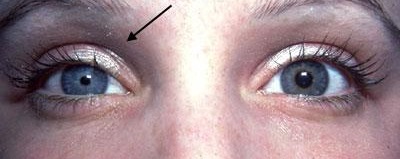 Миотики - глазные капли суживающие зрачок