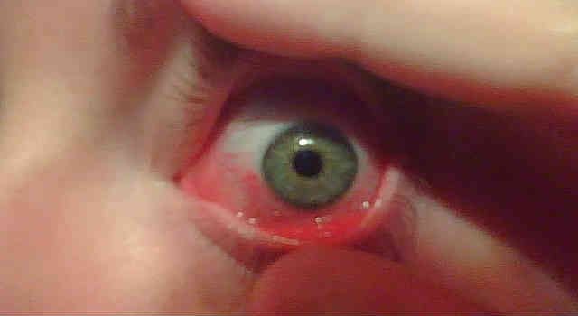 Тенонит глаза лечение
