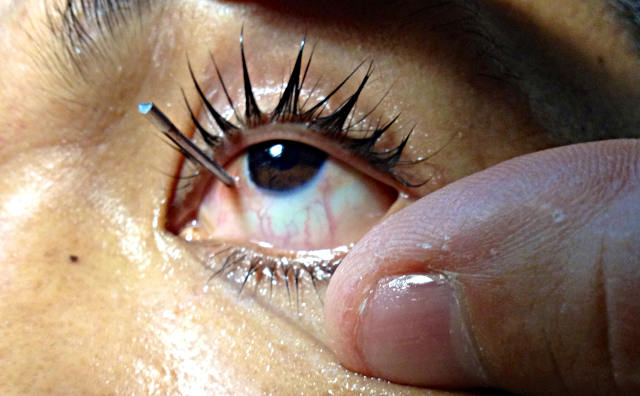 Лечение травмы глаза в Москве