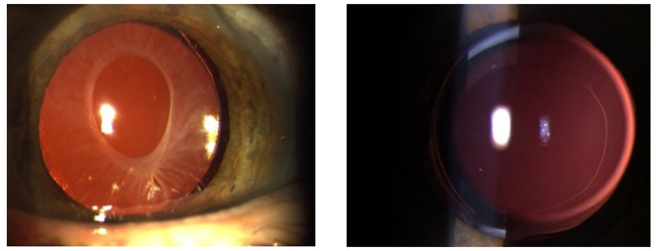 Вторичная катаракта  при ИОЛ AcrySof® Alcon – 48% (слева) и Tecnis J&J – 4% (справа)