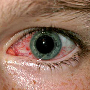 Кератит - воспаление роговицы глаза
