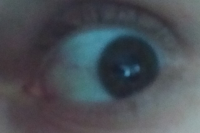 Красные глаза и сосуды после лазерной коррекции зрения ФемтоЛАСИК