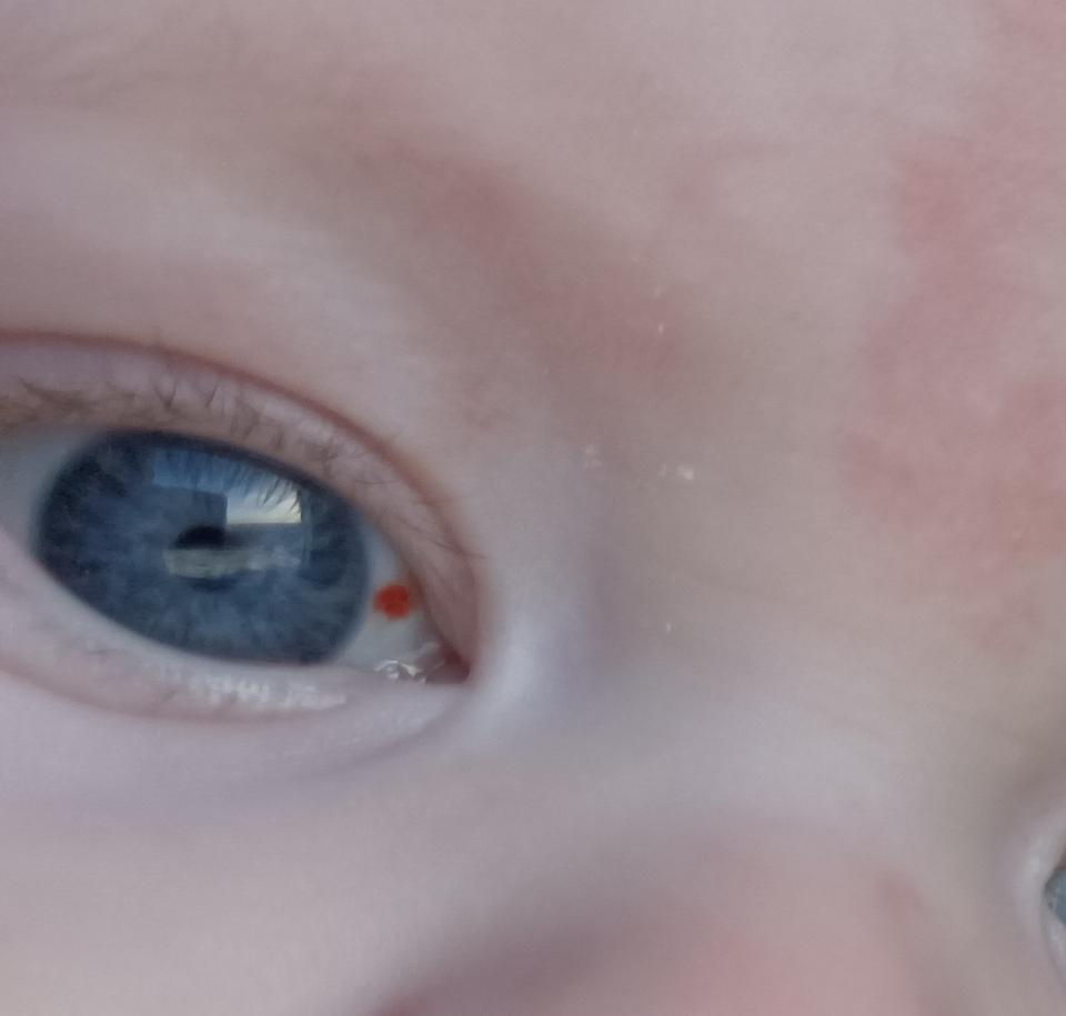 Кровоподтек в углу глаза у ребенка