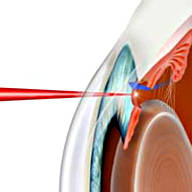 Лазерные операции при глаукоме