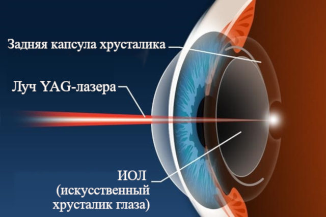 ИАГ-лазерная дисцизия вторичной катаракты (схема операции)