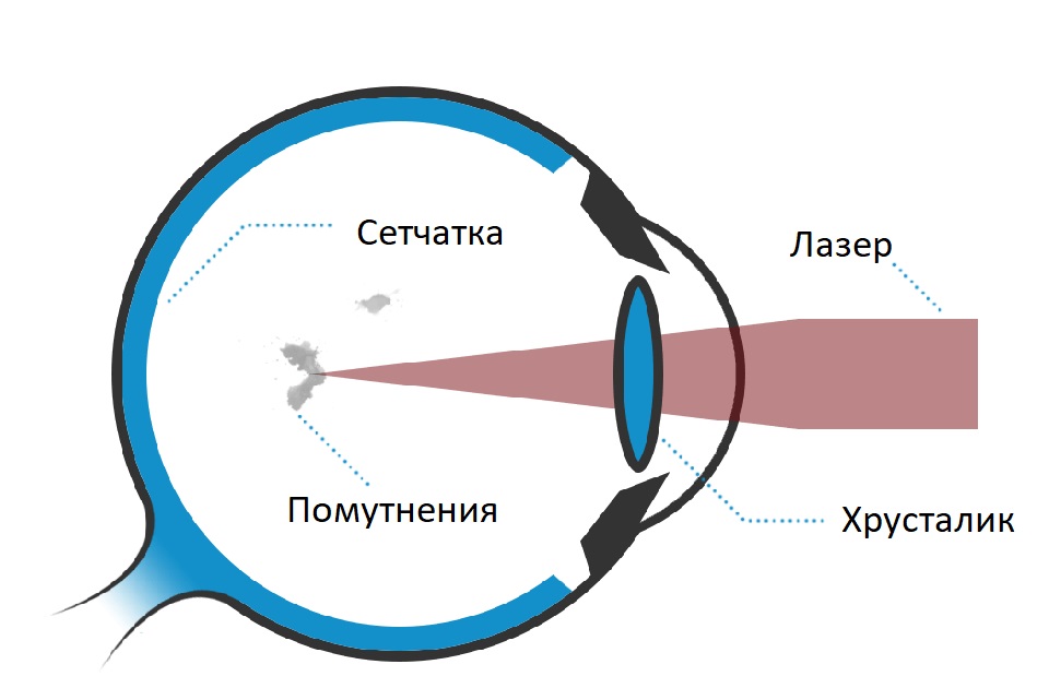 Лазерный витреолизис в Москве - стоимость операции