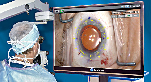 Удаление катаракты глаза с помощью фемтосекундного лазера