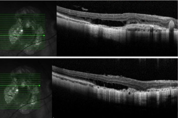 Миопическая макулопатия - оптическая когерентная томография глаза