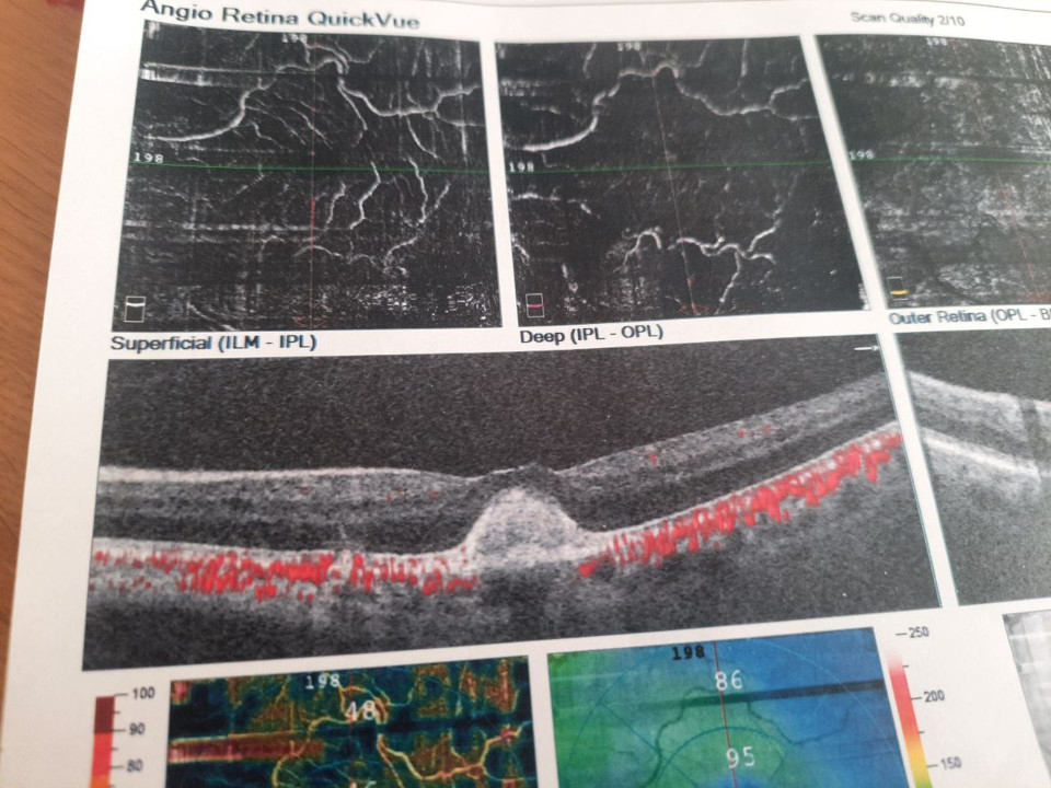 МРТ макулы сетчатки глаза - к кому обращаться