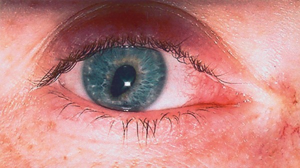Овальный зрачок после операции по замене хрусталика при катаракте