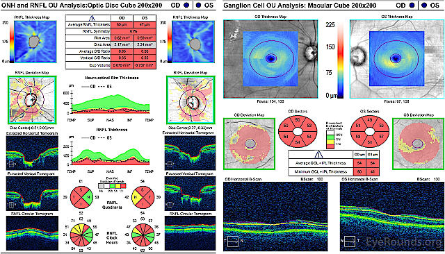 Оптическая когерентная томография диска зрительного нерва