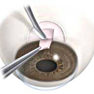 Операция на глаза при глаукоме