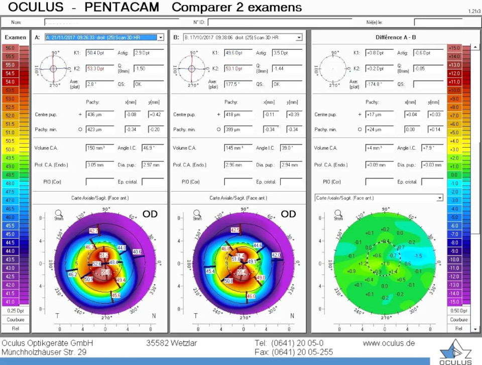 Цена на обследование глаз в офтальмологии на Pentacam AXL (пентакам) в Москве