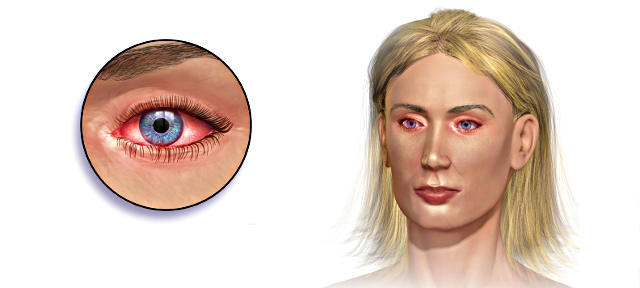 Аллергия на глазах - причины и симптомы