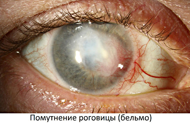 Последствия эрозии роговицы глаза