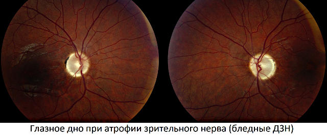 Причины и симптомы атрофии зрительного нерва глаза (ЧАЗН)