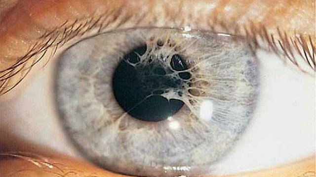 Синехии глаза симптомы