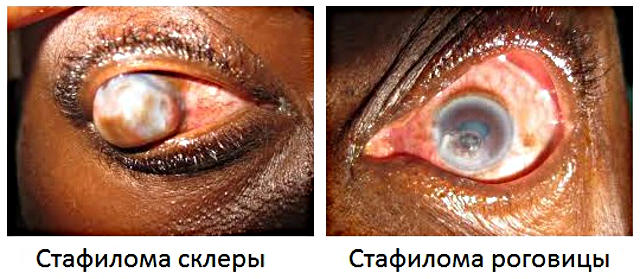 Стафилома глаза: роговицы и склеры