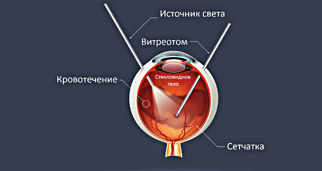 Витреоретинальная хирургия глаза в Москве