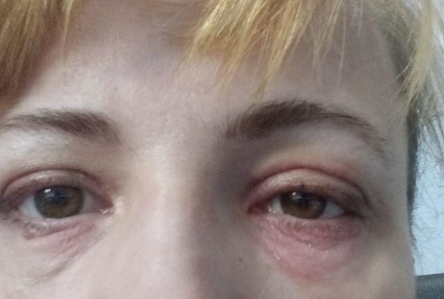 Покраснение кожи вокруг глаз - причины и лечение