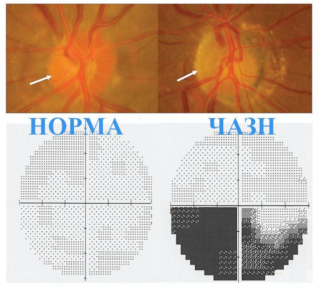 Глазное дно и поля зрения в норме и при частичной атрофии зрительного нерва