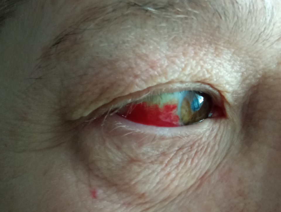 Що робити при крововиливі в око?