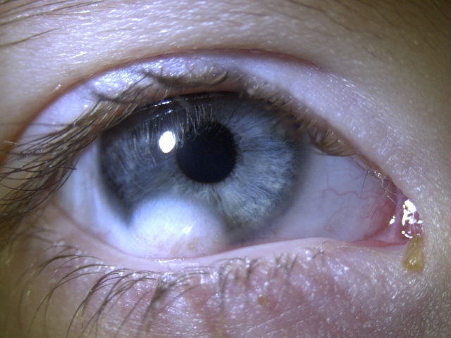 Клиника по лечению помутнений роговицы глаза в Москве