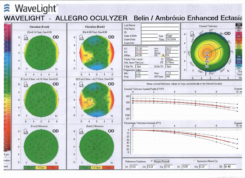 Признаки кератоконуса и лазерная коррекция зрения