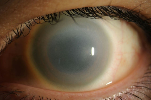 Помутнение роговицы - противопоказание к лазерному лечению вторичной катаракты