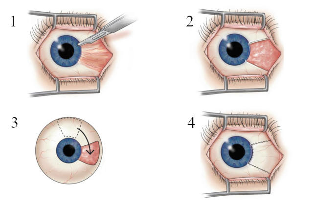 Операция по удалению птеригиума глаза