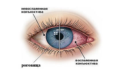 Причины птеригиума глаза