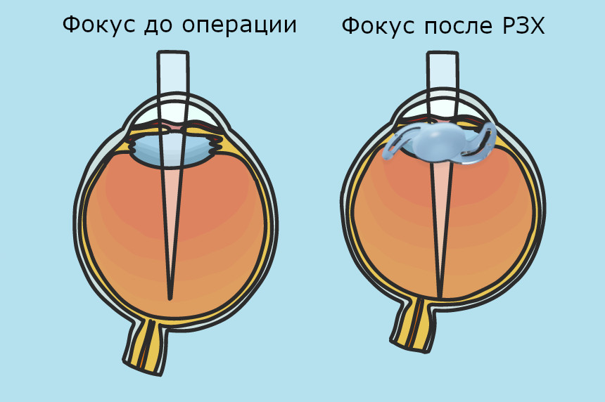 Рефракционная замена хрусталика (РЗХ) с целью улучшения зрения в Москве