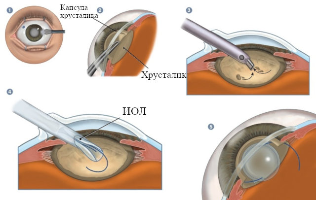 Схема ультразвуковой факоэмульсификации катаракты с имплантацией ИОЛ - интраокулярной линзы